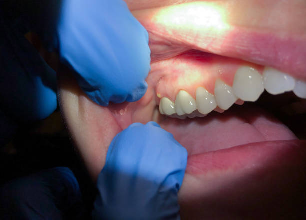 Best Cracked Tooth Emergency Dentist  in Mission, OR
